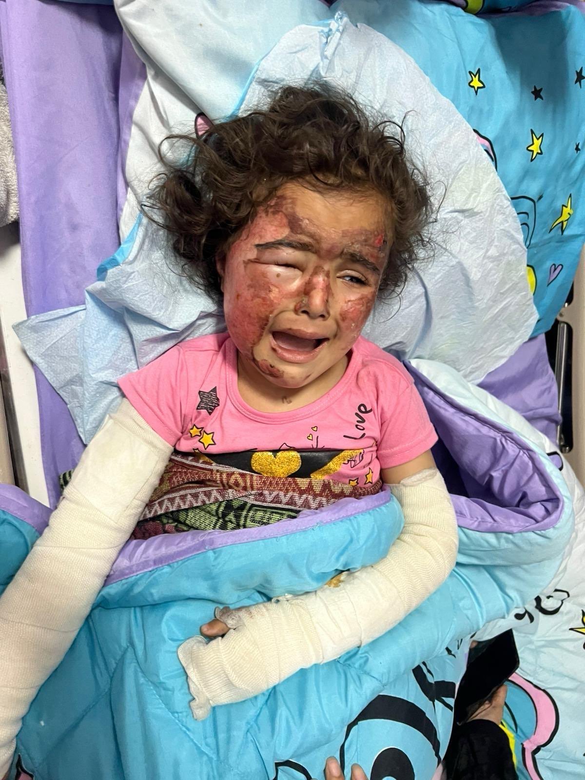 A child recovering from severe burns.